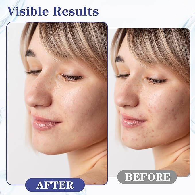SINPIN aobenz Control Gel with 2% Salicylic Acid & Botanical Extracts | Acne Treatment for Face & Body, Gentle for All Skin, Natural & Fast Relief, 1.7FL